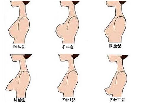 假体隆胸可以改善乳房下垂