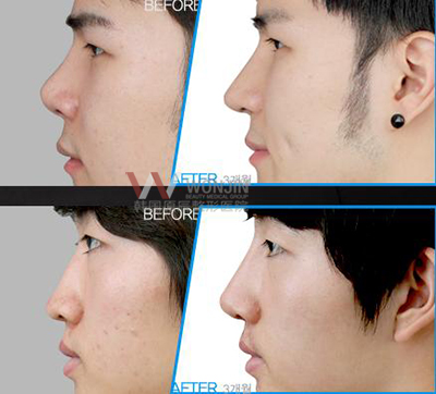 韩国医生郑东学和朴原辰哪个做隆鼻手术好？