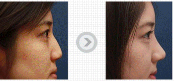 韩国栋达拉斯隆鼻的鼻头缩小手术案例