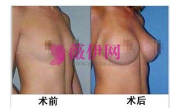 ​自体脂肪隆胸术后恢复案例图