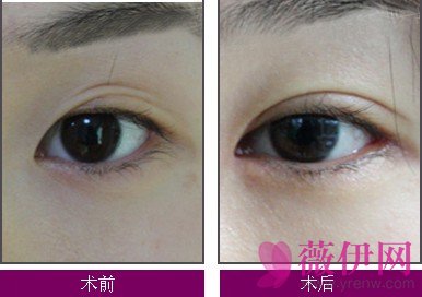 杨群双眼皮修复案例