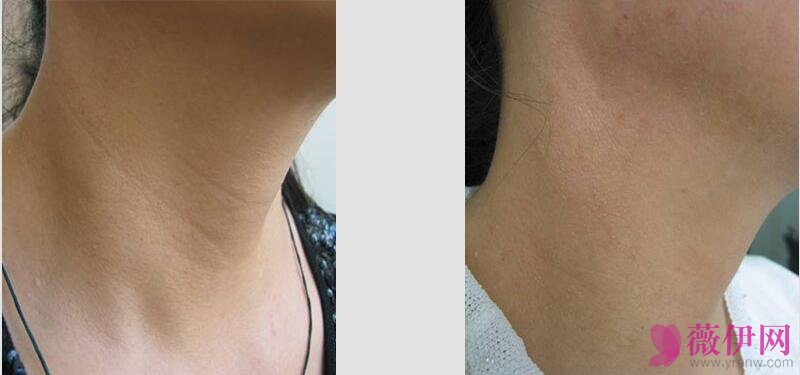 颈纹修复回春疗法