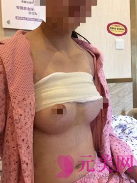 自体脂肪隆胸手术真人恢复过程日记 前后对比照片