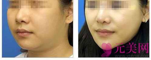 广州面部吸脂案例|面部吸脂手术果对比图