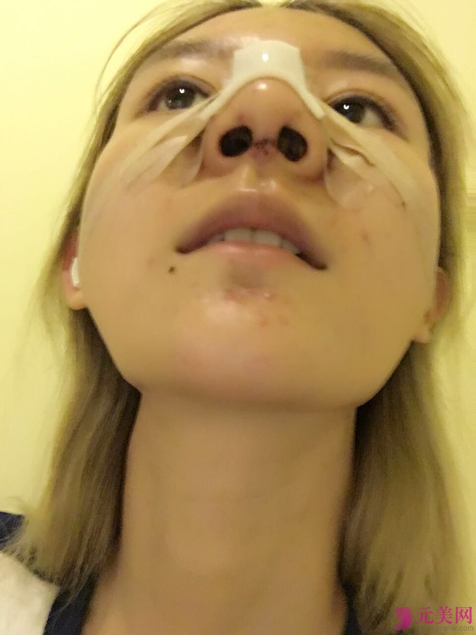 北京炫美张海龙鼻部手术真人案例恢复图
