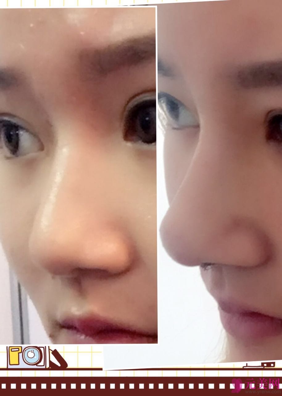 北京炫美张海龙鼻部手术真人案例恢复图