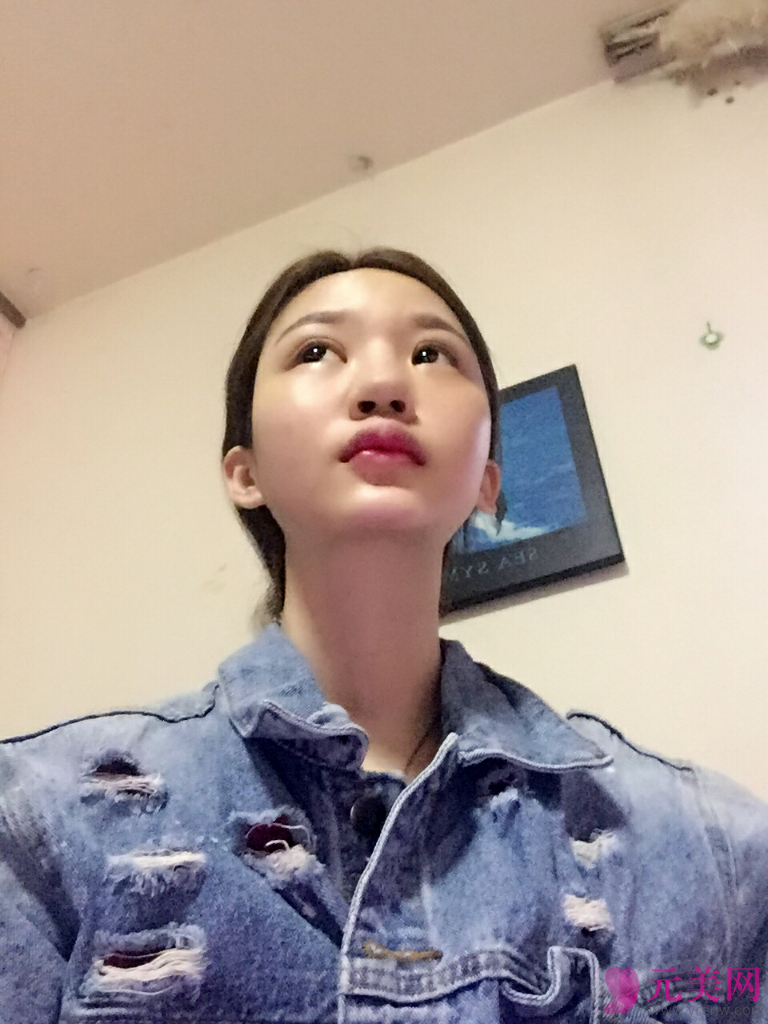 北京薇琳田秋梅耳软骨垫鼻尖和硅胶隆鼻案例