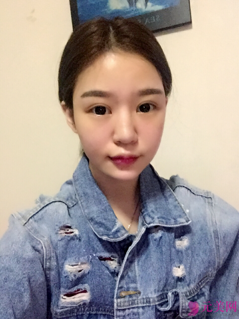 北京薇琳田秋梅耳软骨垫鼻尖和硅胶隆鼻案例